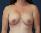 Feel Beautiful - Breast Lift San Diego 20 - After Photo